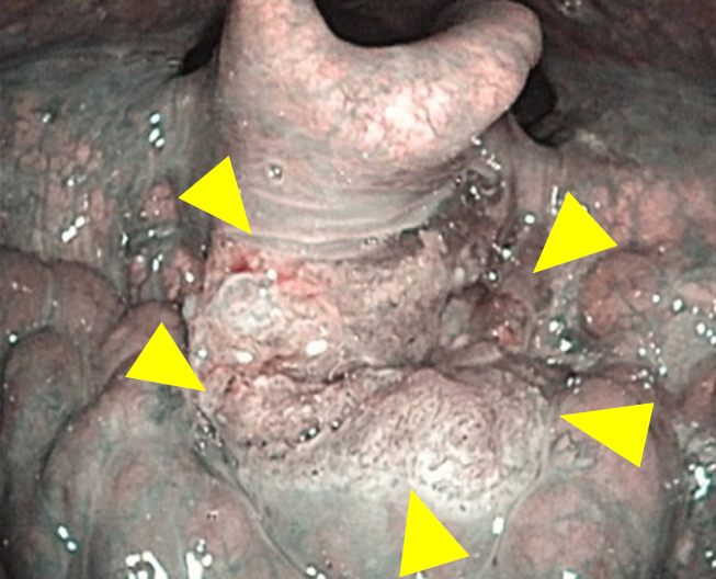 中咽頭がんにおけるNBI 写真