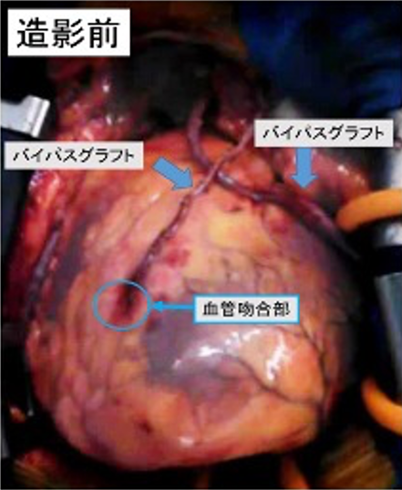 冠動脈グラフトの術中血流評価 造影前 写真