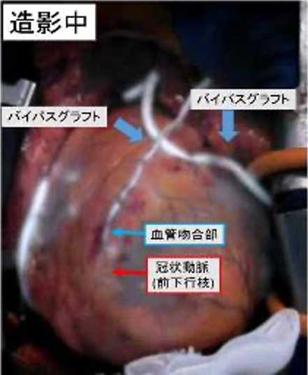 冠動脈グラフトの術中血流評価 造影中 写真