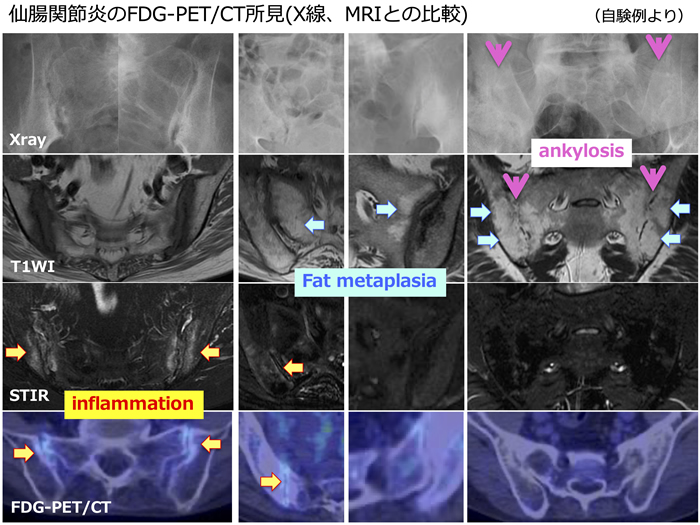 仙腸関節炎のFDG-PET/CT所見（X線、MRIとの比較）