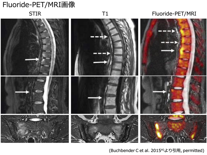 Fluoride-PET/MRI画像