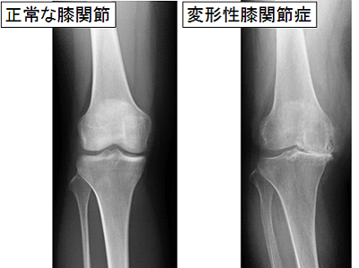 正常な膝関節と変形性膝関節症