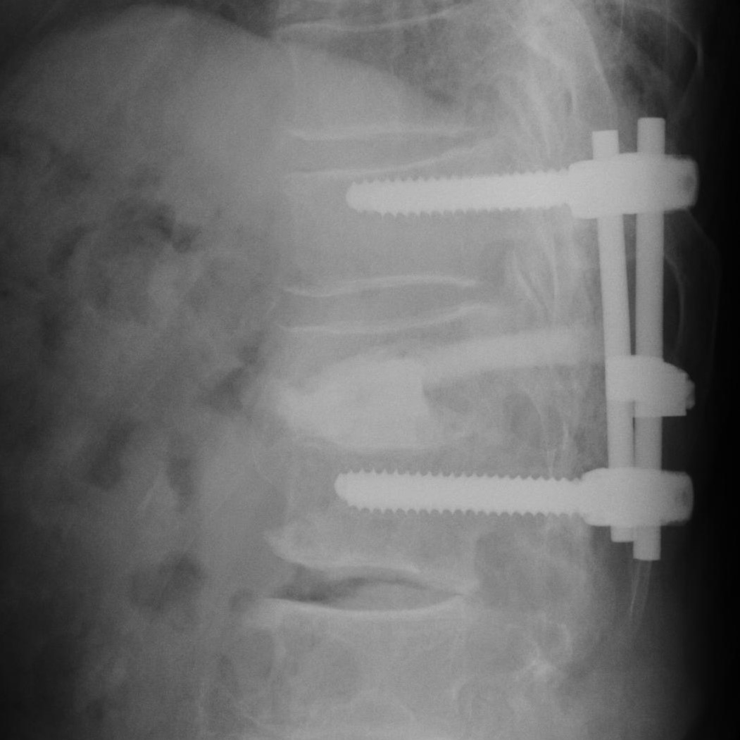 CPCの椎体椎間板充填による前方支柱再建
