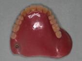 顎義歯