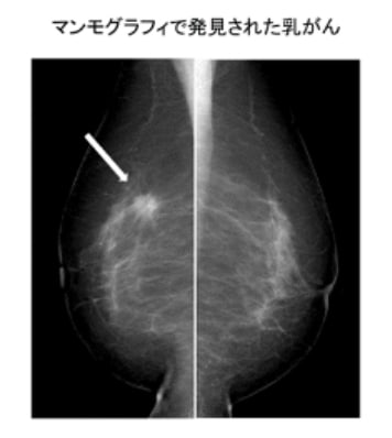 マンモグラフィで発見された乳がん