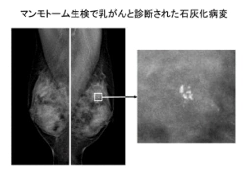 マンモトーム生検で乳がんと診断された石灰化病変