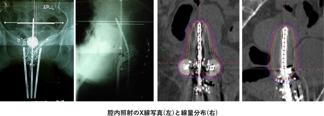 腔内照射のX線写真(左)と線量分布(右)