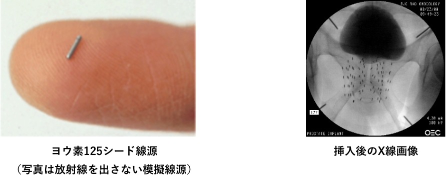 左：ヨウ素125シード線源（写真は放射線を出さない模擬線源）、右：挿入後のX線画像