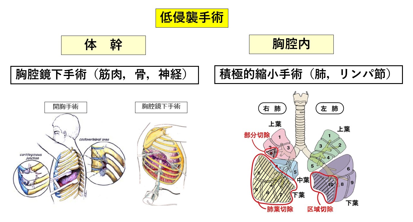 手術などの治療法｜高知大学医学部 呼吸器外科学講座