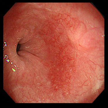 食道がんにおけるNBI 写真