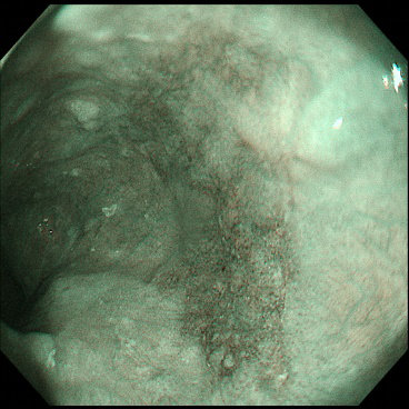 食道がんにおけるNBI 写真