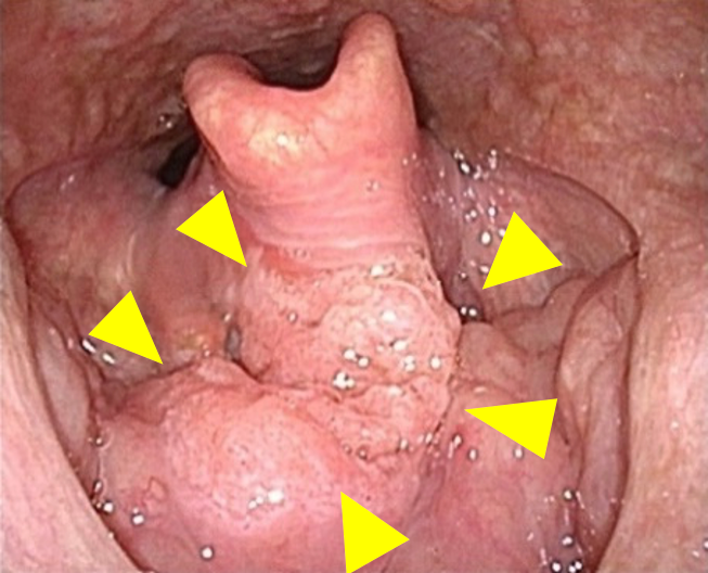 中咽頭がんにおけるNBI 写真