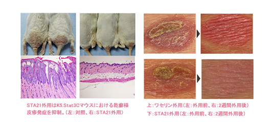 Stat3阻害薬による乾癬の新規治療法