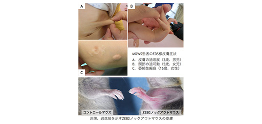 Mowat-Wilson症候群の原因遺伝子ZEB2のコラーゲン合成経路への関与