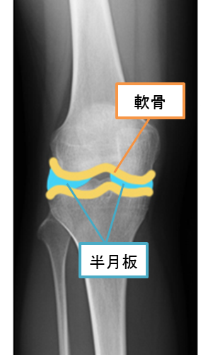 変形性膝関節症