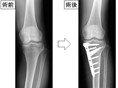 高位脛骨骨切り術