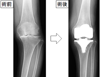 人工関節置換術