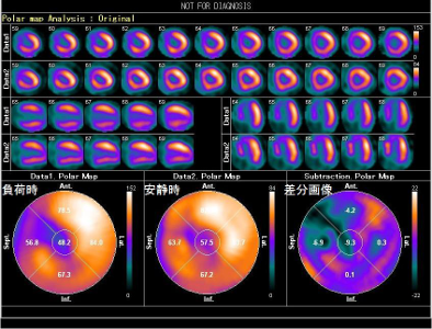 S،V`OtB(Heart Score View)