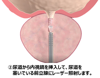 ②尿道から内視鏡を挿入して、尿道を塞いでいる前立腺にレーザー照射します。