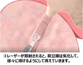 ③レーザーが照射されると、前立腺は気化して、徐々に溶けるようにして消えていきます。