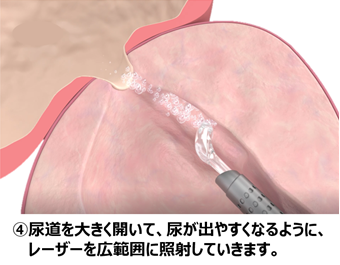 ④尿道を大きく開いて、尿が出やすくなるように、レーザーを広範囲に照射していきます。