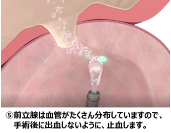 ⑤前立腺は血管がたくさん分布していますので、手術後に出血しないように、止血します。