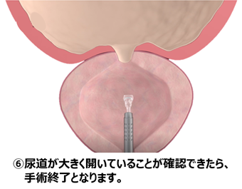 ⑥尿道が大きく開いていることが確認できたら、手術終了となります。