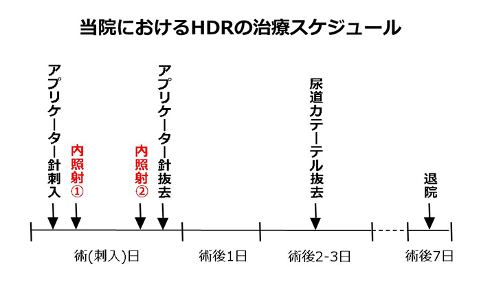 当院におけるHDRの治療スケジュール