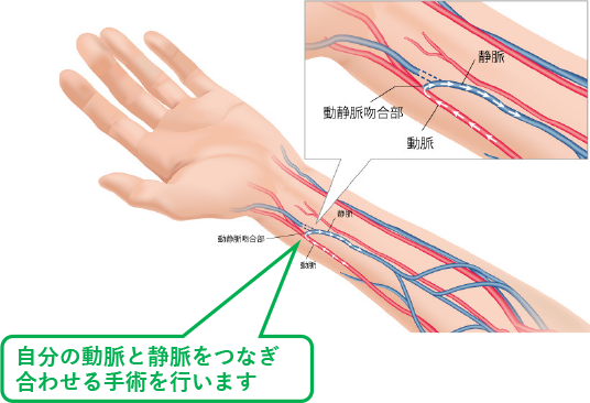 図4：自分の動脈と静脈をつなぎ合わせる手術を行う説明のイラスト