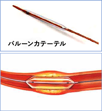 図5：バルーンカテーテルの画像