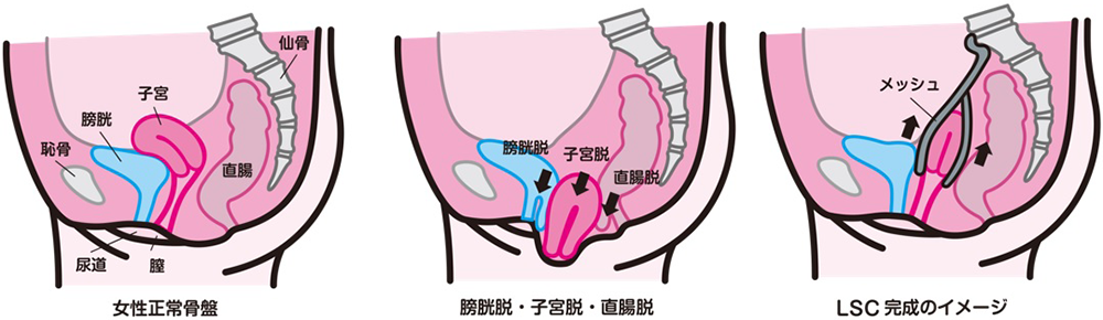 図1：女性正常骨盤、膀胱脱・子宮脱・直腸脱、LSC完成のイメージ画像