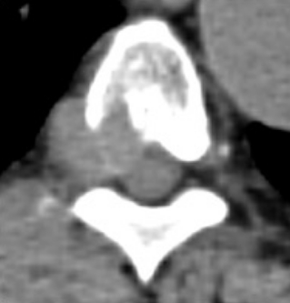 転移性脊髄圧迫