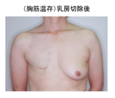 乳房切除後