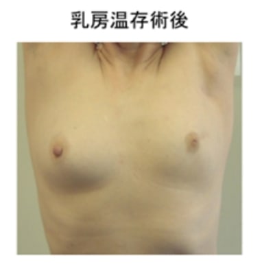 乳房温存術後