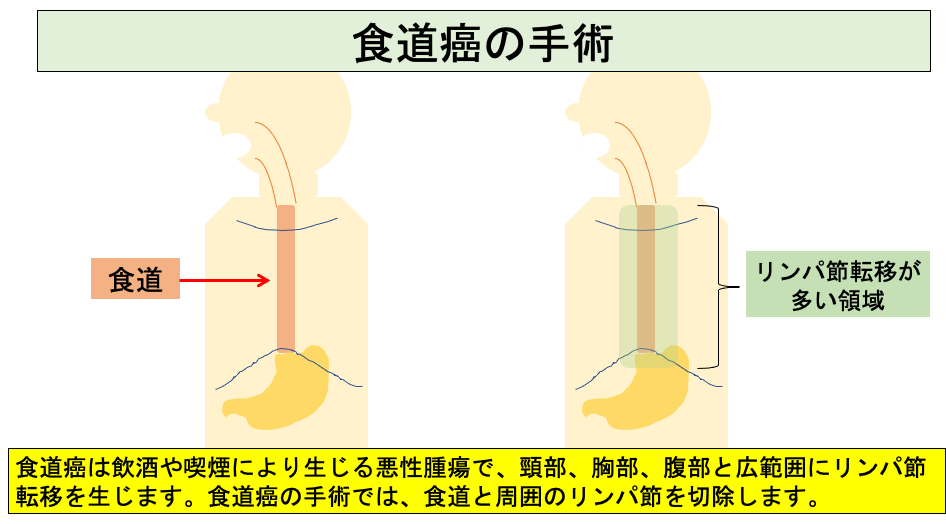 食道癌の手術