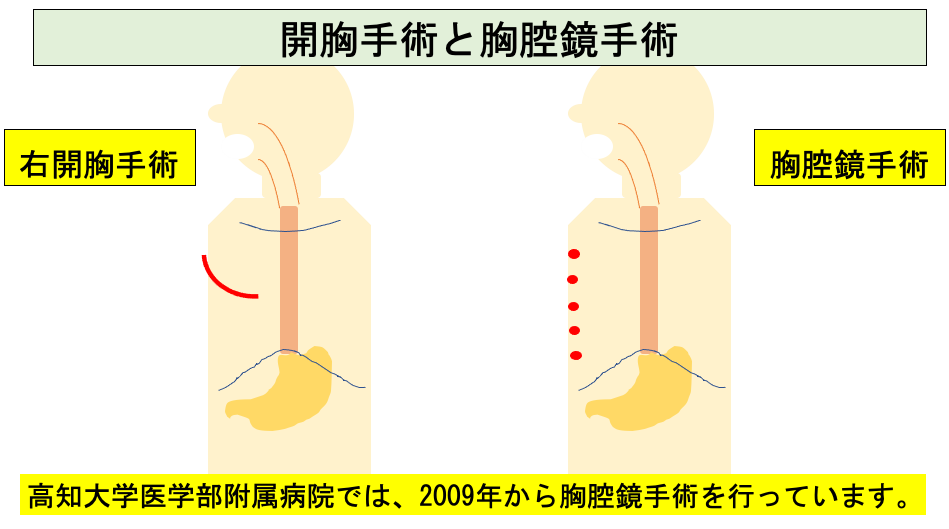 食道癌の開胸手術と胸腔鏡手術