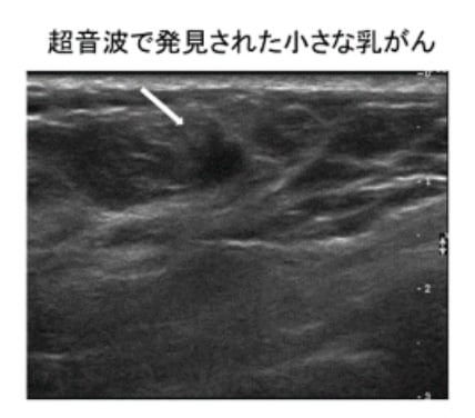 超音波で発見された小さな乳がん