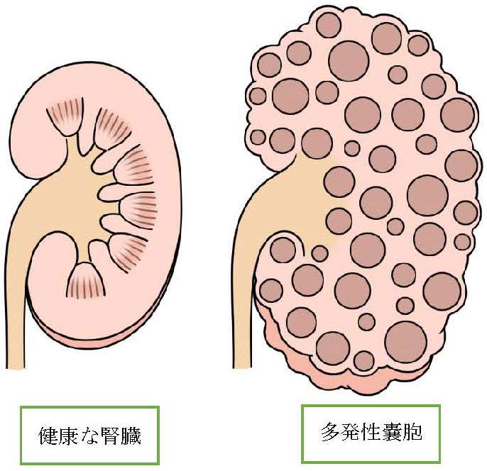 肝 嚢胞