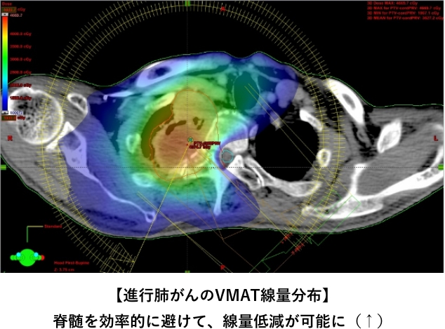 【進行肺がんのVMAT線量分布】脊髄を効率的に避けて、線量低減が可能に(↑)