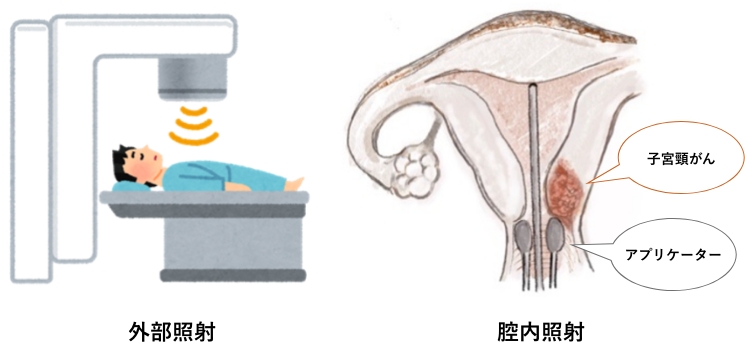 外部照射・腔内照射の図