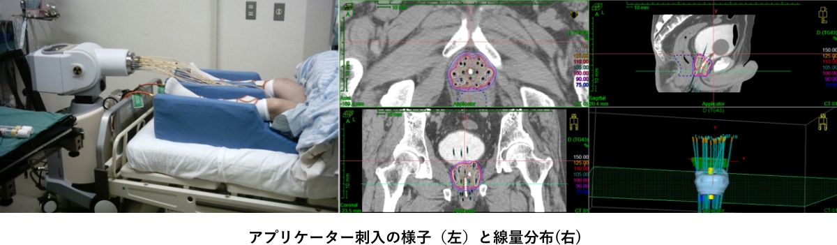アプリケーター刺入の様子（左）と線量分布(右)