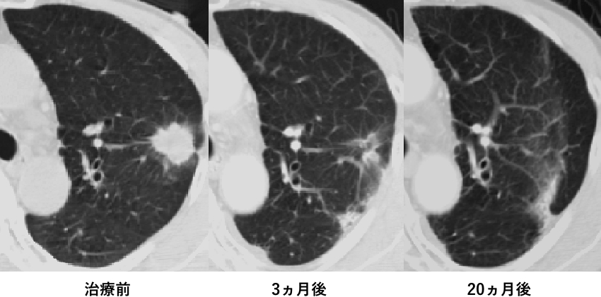 治療前、3ヶ月後、20ヶ月後の様子