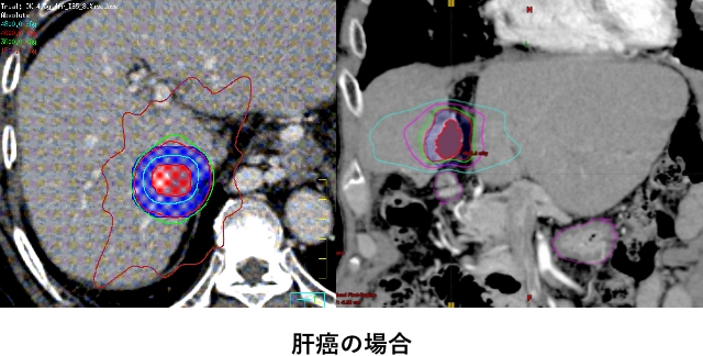 肝癌の場合