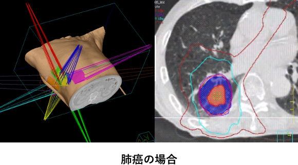 肺癌の場合